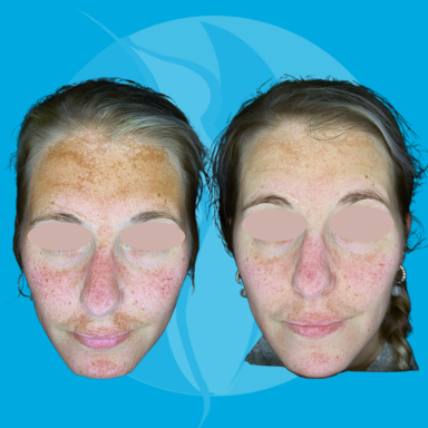 Resultaat na 3 behandelingen Pigmentvlekken