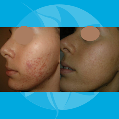 Resultaat na 1 behandeling Acnetherapie