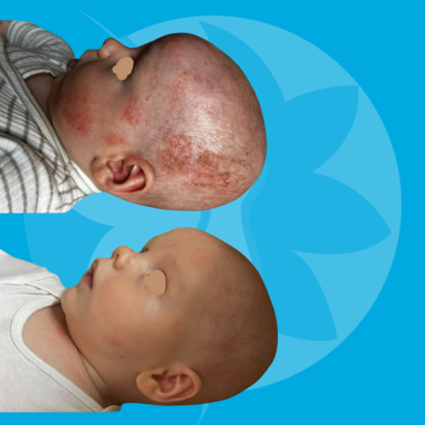 Resultaat na 1 week Eczeembegeleiding