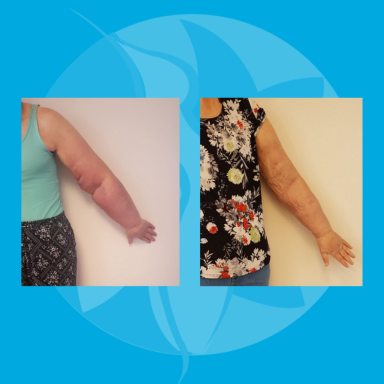 Oedeemtherapie Oedeemtherapie