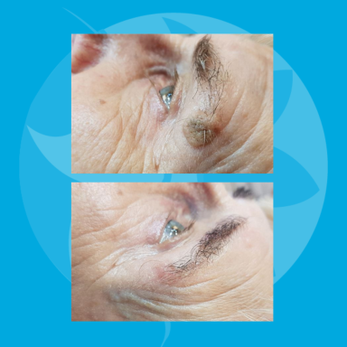 Resultaat na 1 behandeling Ouderdomswrat