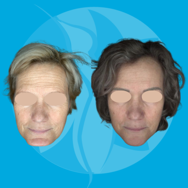 Huidverbetering met microneedling Huidverbetering